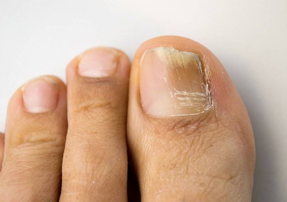 Types of fungal infection on the big toe