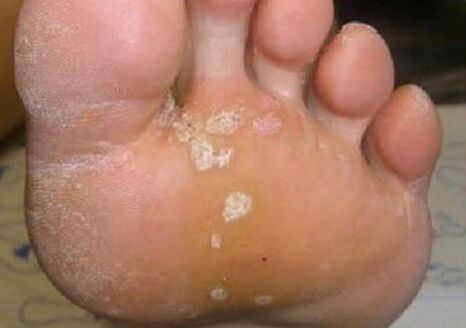 Fungal skin injuries
