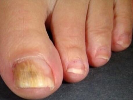 Nail fungi