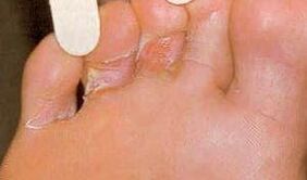 Dermazine injuries for the legs of the foot