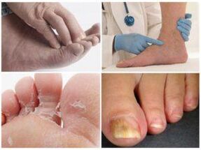 I mycosis stops