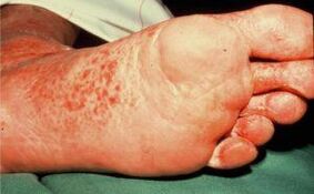 Mushrooms with ulcers on the feet