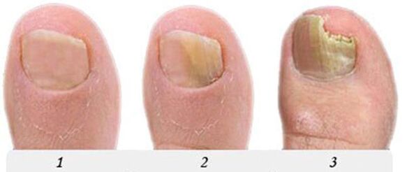 The process of developing fungi on the thumb finger