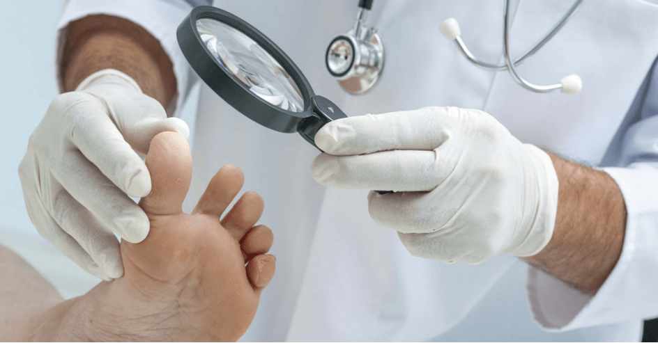 The first symptoms of fungi on the legs