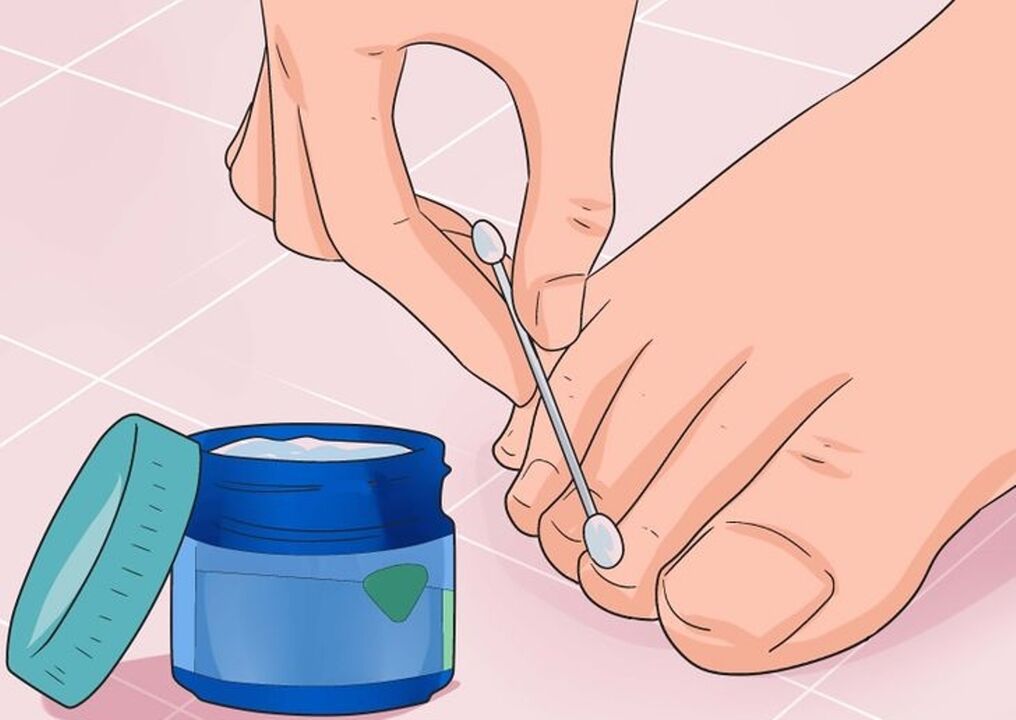 Cure nail fungi