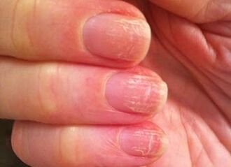 The starting stage of fungi on the nails