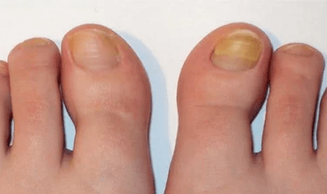 The starting stage of nail fungi