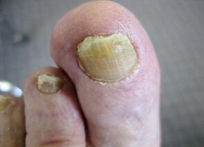 Causes of fungi's appearance on the nails
