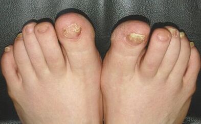 Signs of fungi on the nails