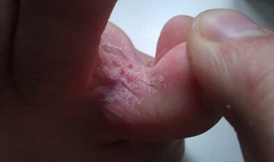 The stages of development of fungi between the fingers