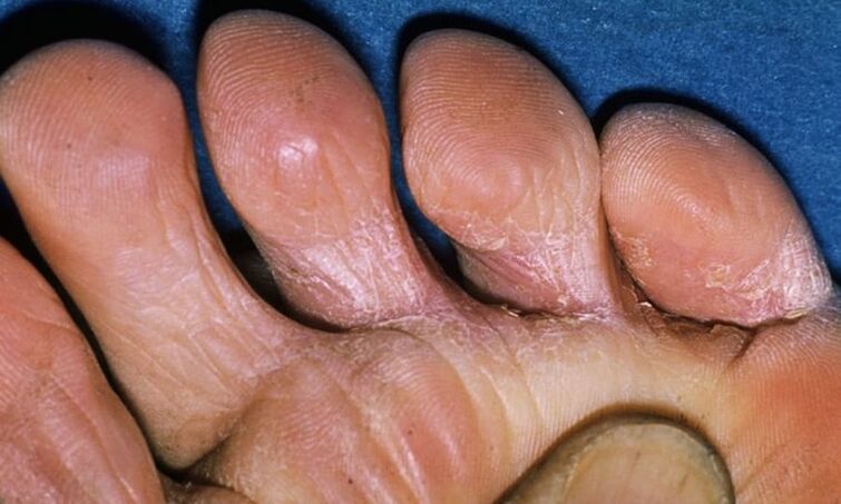 Different types of feet of fungi