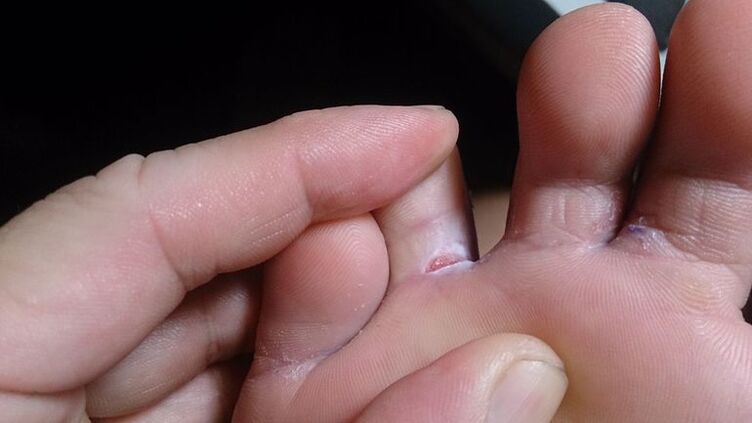 Foot fungi