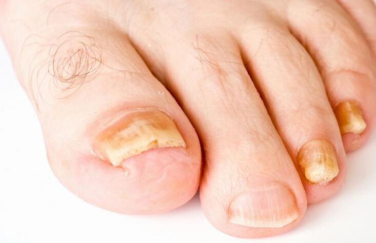 Yellow nails due to fungus
