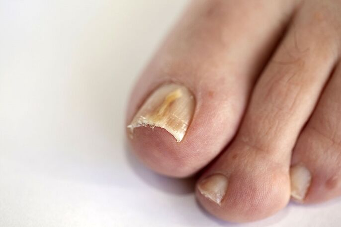 Nail infection due to fungal infection