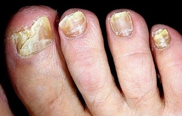 Fungus on toenails