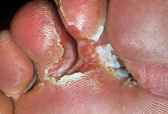 Symptoms of interdigital fungus