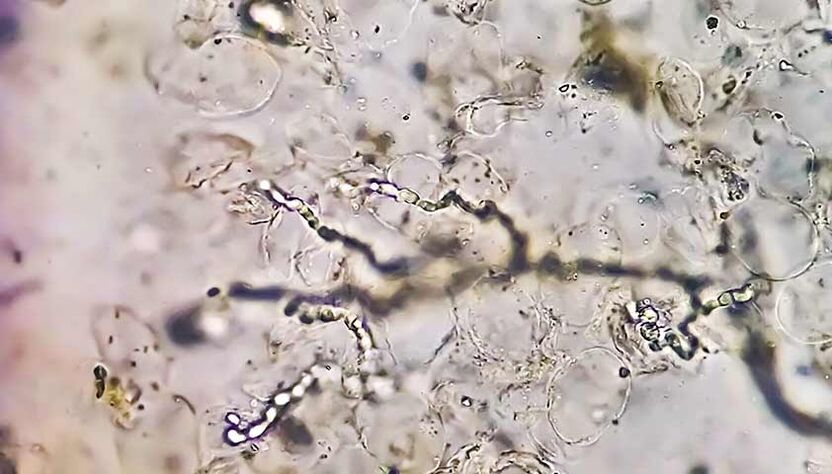 Fungi under the microscope - to blame for the development of mycosis of the feet