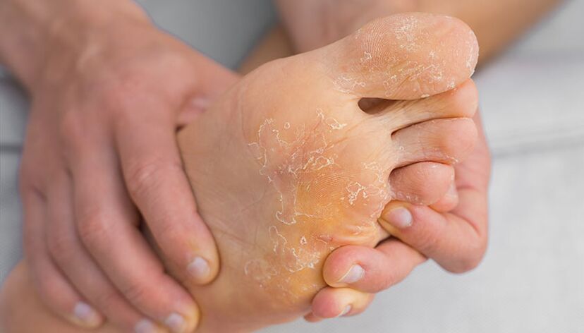 Skin peeling and itching are symptoms of athlete's foot