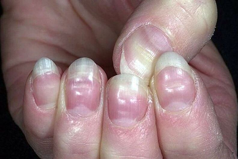 Leukonychia on nails