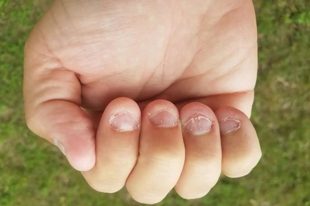 Micronia on the nails