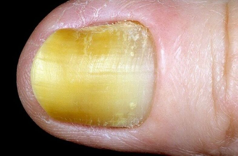 Onycholysis of nails