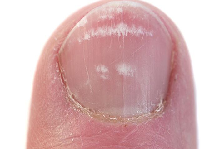 Fungal signs on nails